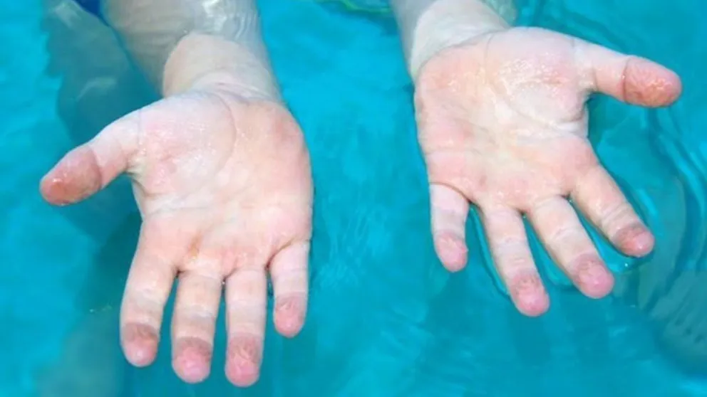 Enterate porqué se arrugan los dedos en el agua