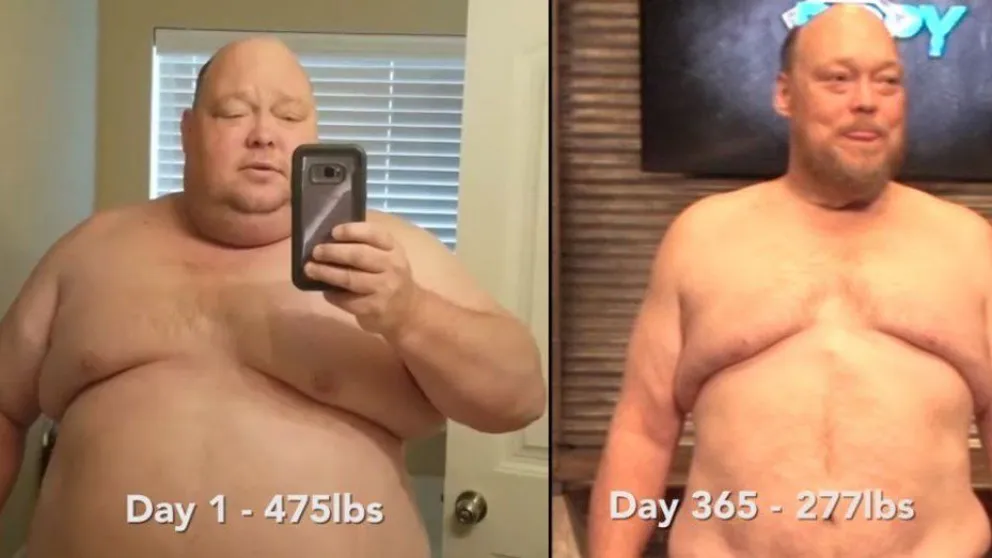 El caso del hombre que tenía obesidad mórbida y bajó 90 kilos en un año