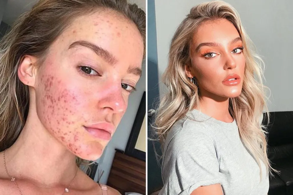 El secreto de esta joven modelo para combatir el acné de su cara