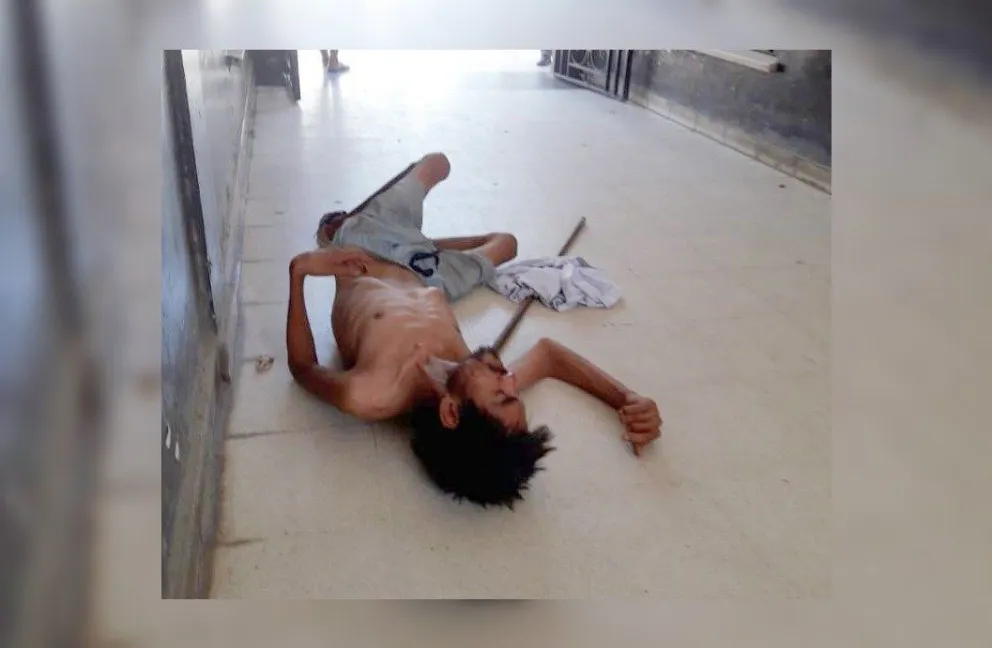 Horror en Salvador Mazza: desgarradoras imágenes de un jovencito  desnutrido