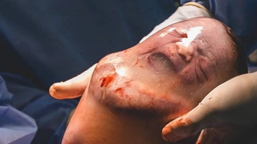 El increíble parto de un bebé que nació dentro del saco amniótico y sobrevivió