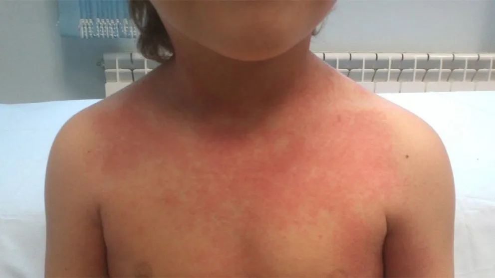 Nuevo ataque de Dengue: ¿Cuántos casos van en Salta?