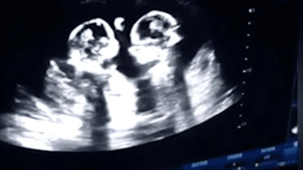 Gemelas se pelean "a las piñas" en el útero de su mamá [VIDEO]