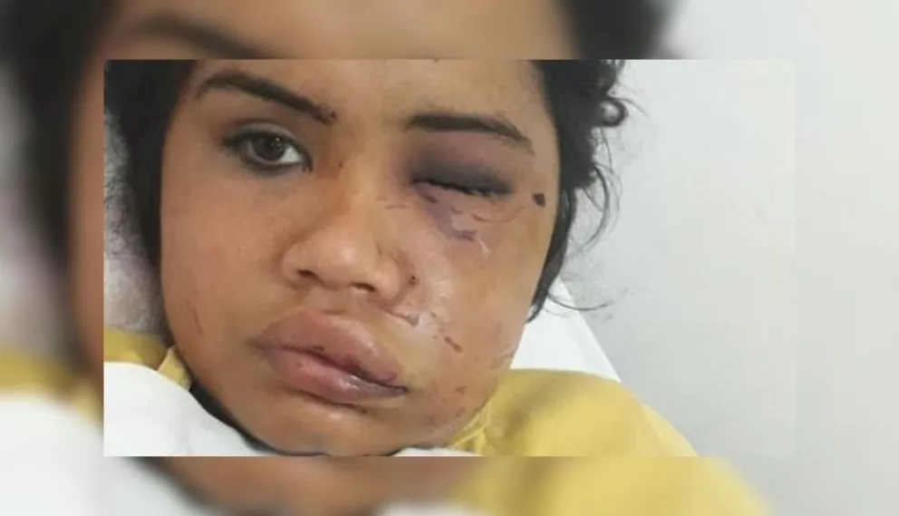 Horror: desfiguraron a golpes a una salteña a la salida del boliche