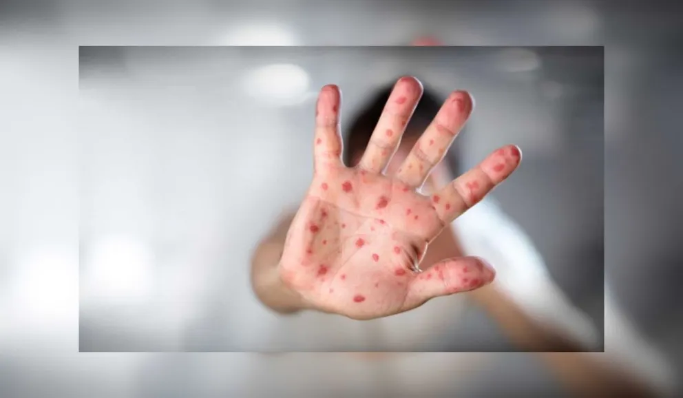 Peligro: cinco niños de una familia "antivacunas" contrajeron sarampión