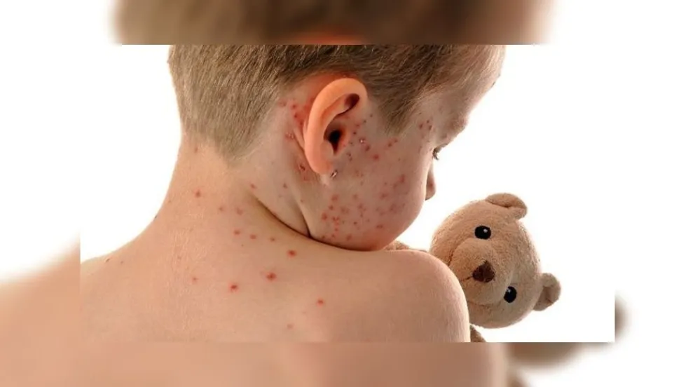 Alerta: piden que vacunen a los niños contra el sarampión