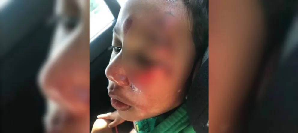 Estremecedor: fue a buscar a su hijito en la guardería y se lo entregaron completamente desfigurado