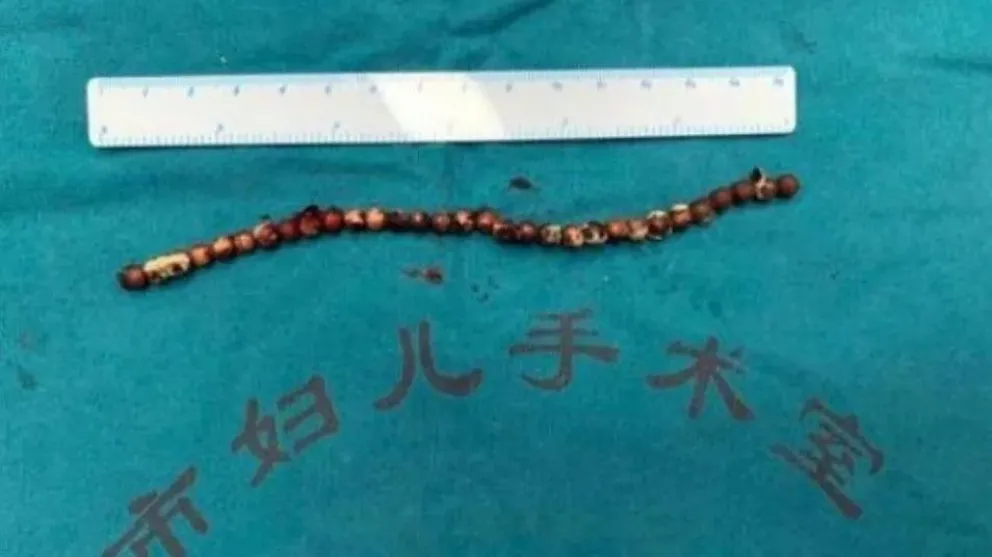 ¡De no creer! Nene se metió 31 bolitas magnéticas en su pene