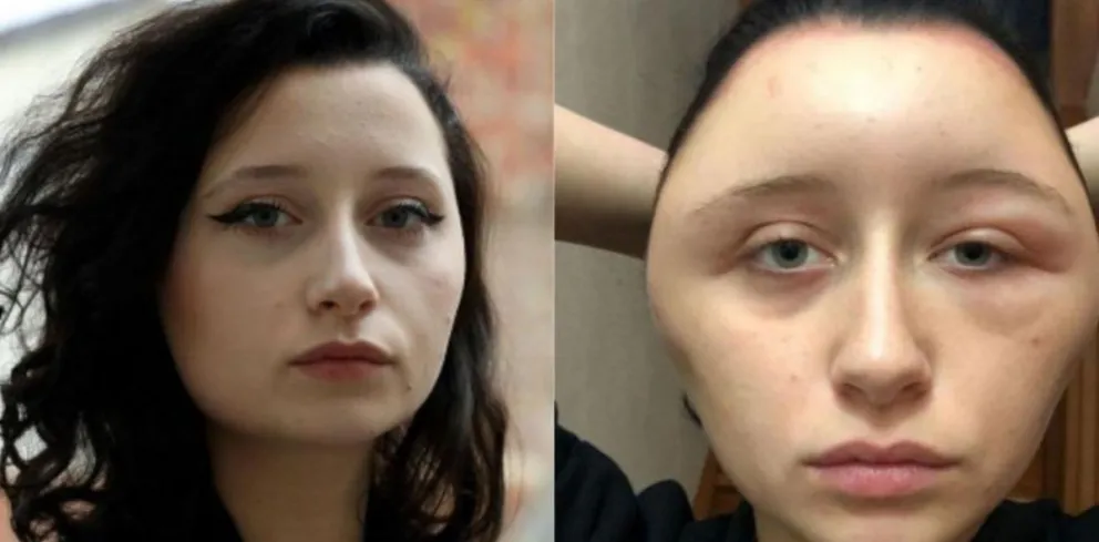 "Casi muero": Una joven acaba con la cabeza totalmente deformada tras teñirse el pelo [VIDEO]