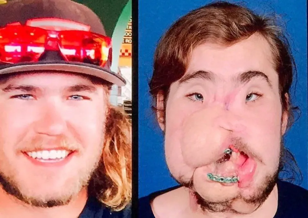 Increíble historia: intentó suicidarse y le salió mal. Gracias a un transplante de cara recuperó su vida