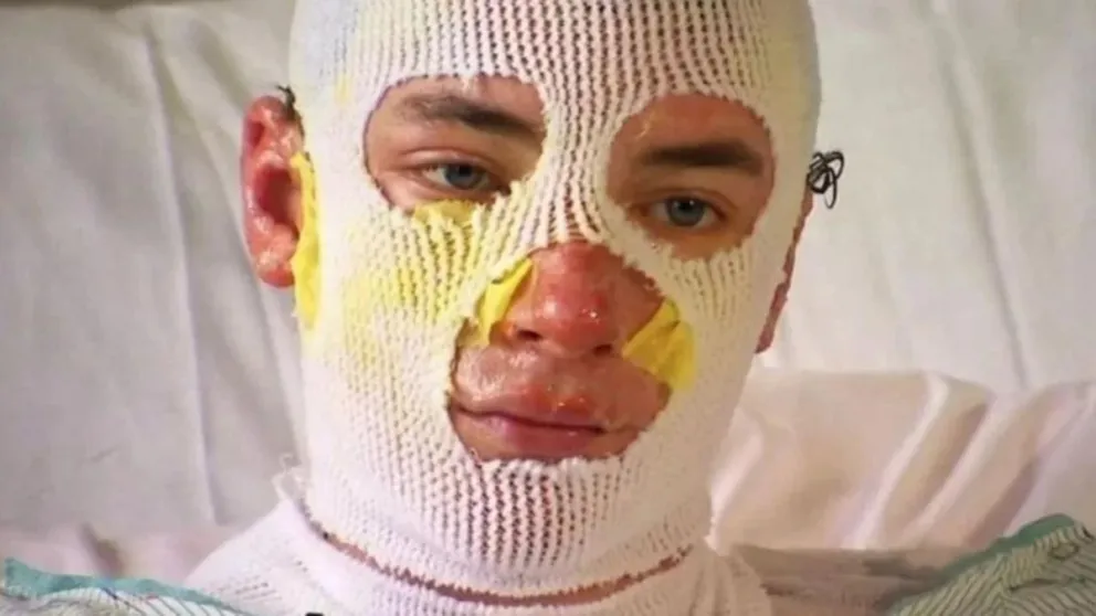 Joven héroe: se quemó todo el cuerpo para salvar a sus sobrinos