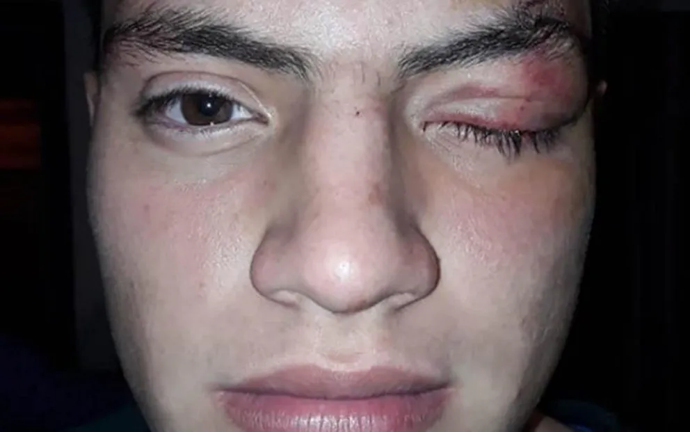 Patovicas violentos: le desfiguraron la cara a un chico en un boliche salteño