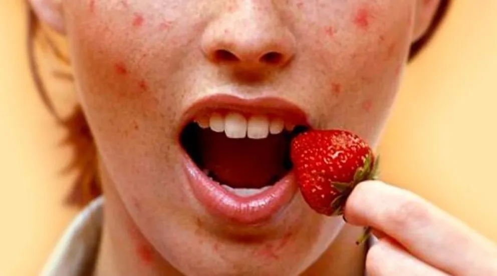 Alergias alimentarias: ¿Qué deberías tener en cuenta?