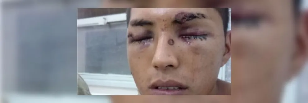 Lo dejaron a la miseria y podría perder su único ojo: quiénes son los policías que atacaron brutalmente a Luciano