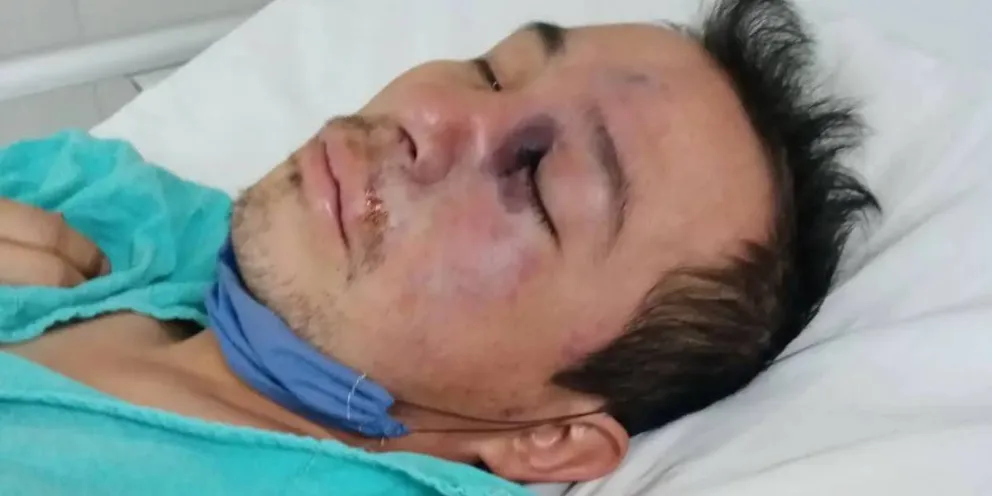 Alertan acerca del vínculo entre la coinfección fúngica y el hongo negro en pacientes con COVID-19